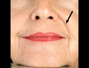 "法令紋" 的英文怎麼說?