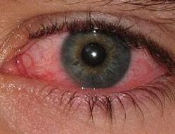 pink eye 是什麼意思?